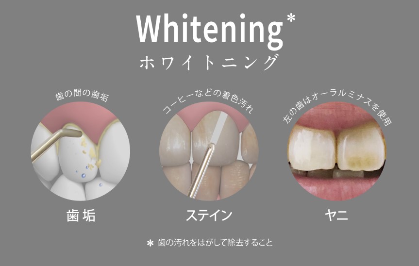 着色やヤニを落としてホワイトニング